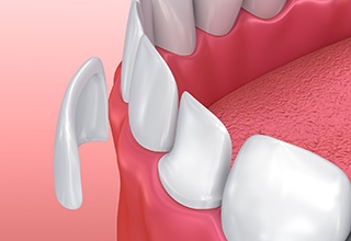 Illustration of a veneer being placed over the front of a tooth