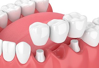 Illustration of a dental bridge filling the gap between two teeth
