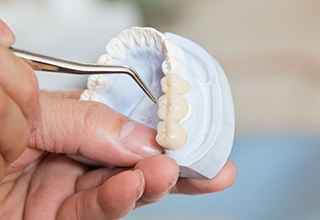 Model smile with implant supported fixed bridge
