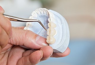 Model of the mouth with a dental bridge