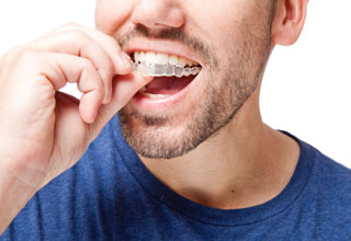 Man placing an Invisalign aligner over his teeth