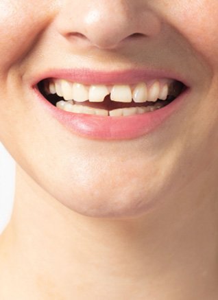 Repair a broken tooth near Mendota Heights