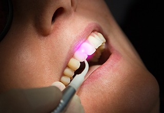 Close up of a dental patient receiving laser gum disease treatment in Inver Grove Heights