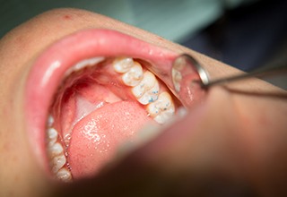 Patient's smile during tooth-colored filling placement