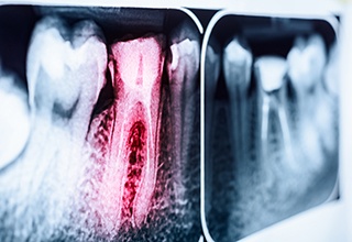 X-ray with one red highlighted tooth