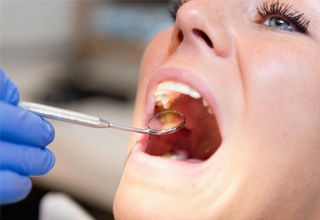 Dental mirror in a patients open mouth