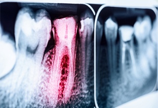 X ray of the teeth with one tooth highlighted red