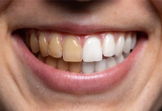 Side-by-side image of stained and whiter teeth