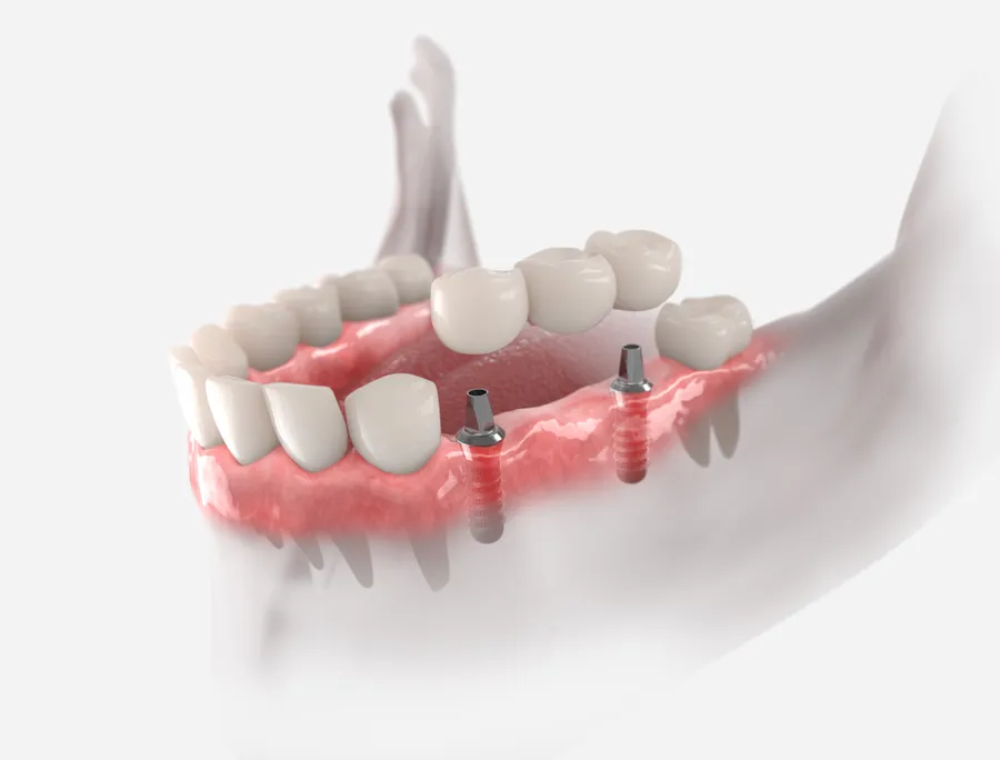 Implant-supported dental bridge illustration