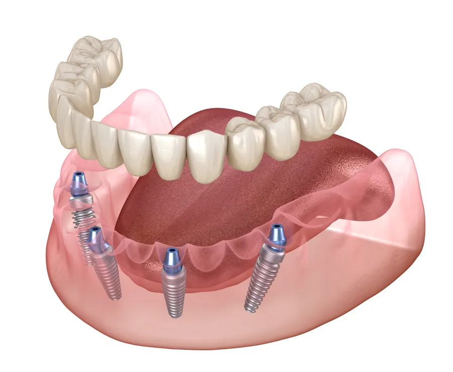 Implant-supported dentures illustration