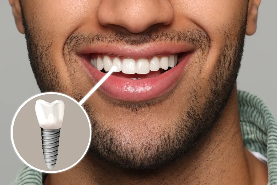 Single tooth dental implant illustration